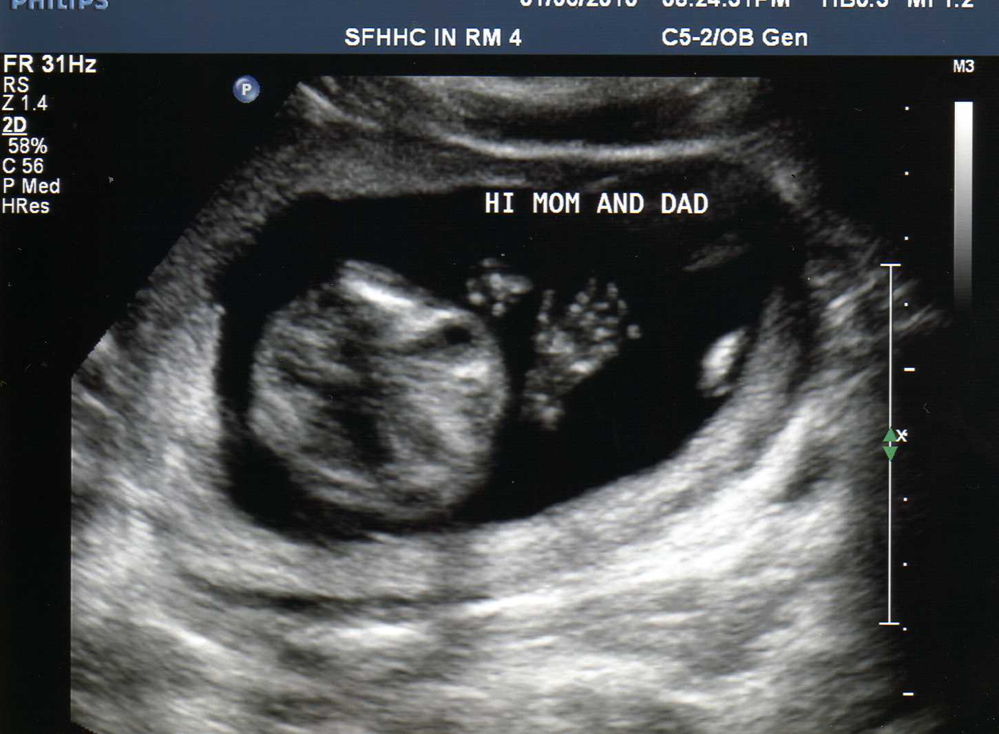 Шестнадцати недель. Плод на 16 неделе беременности УЗИ. УЗИ ребенка на 16 неделе беременности. УЗИ 16 недель беременности фото.